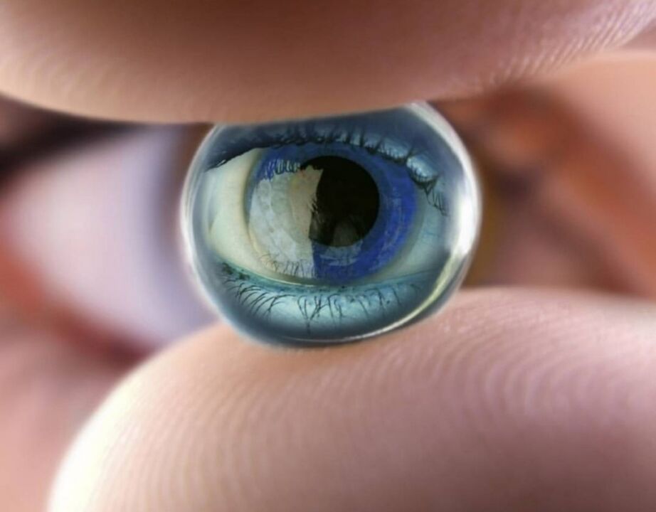 Nuecht orthokokerologesch Lënsen stoppen de Fortschrëtt vu visueller Behënnerung