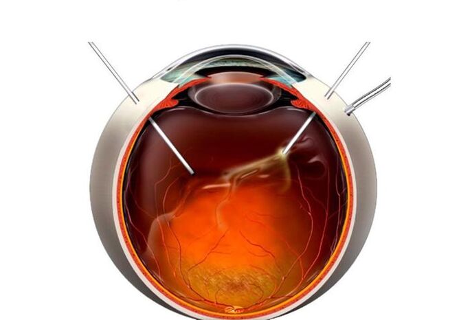 Vitrektomie - Chirurgie fir d'Visioun ze restauréieren